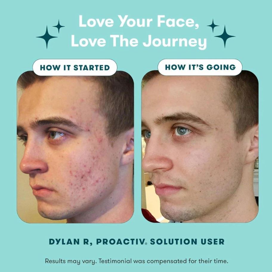 Image showing a customer's progress with the Proactiv solution, showing clearer skin
